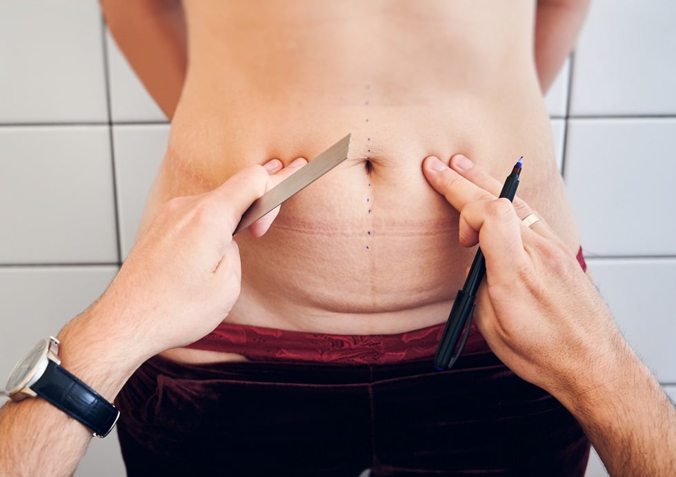 Abdominoplasty