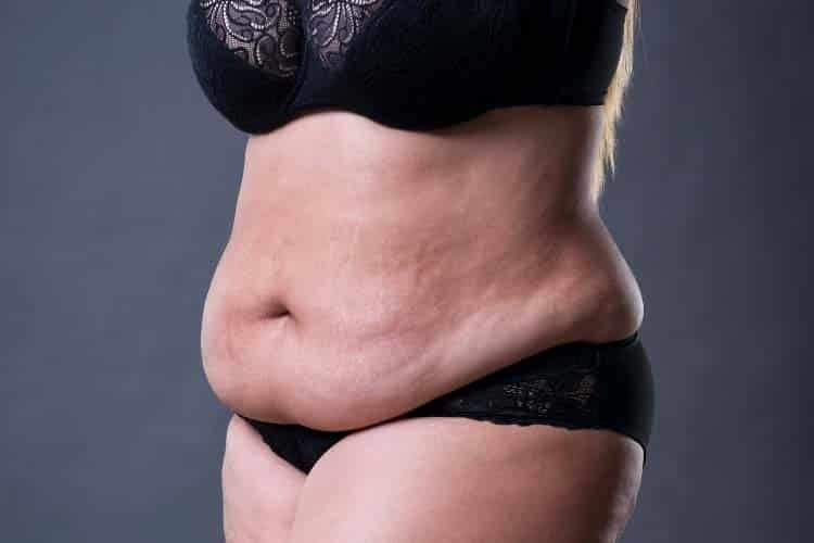 cirugia_postbariatrica