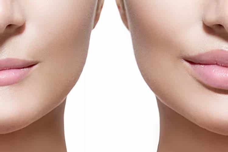 relleno_labios
